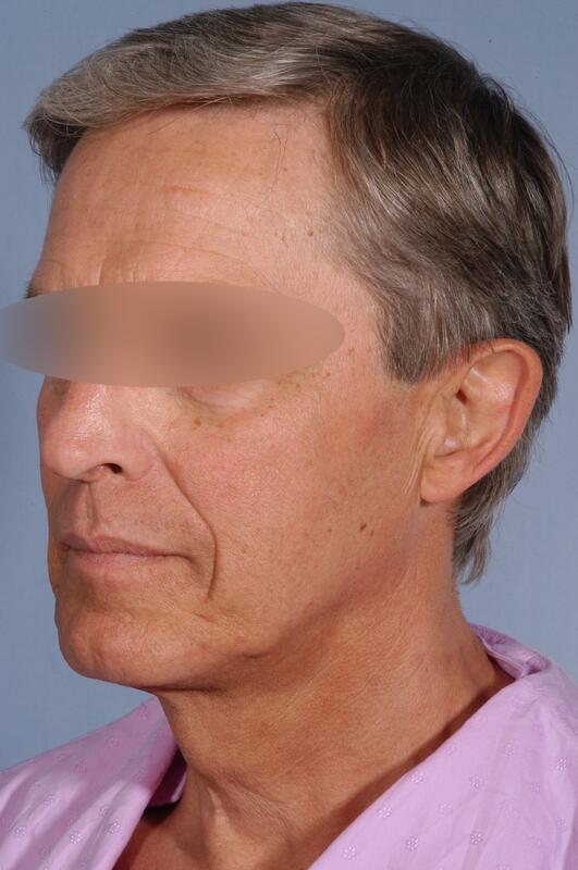 Male facelift Before & After Image