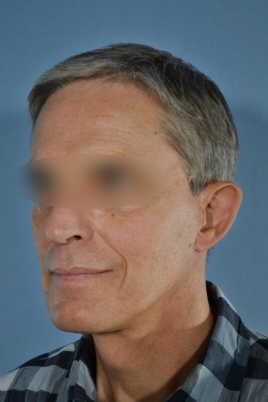 Male facelift Before & After Image