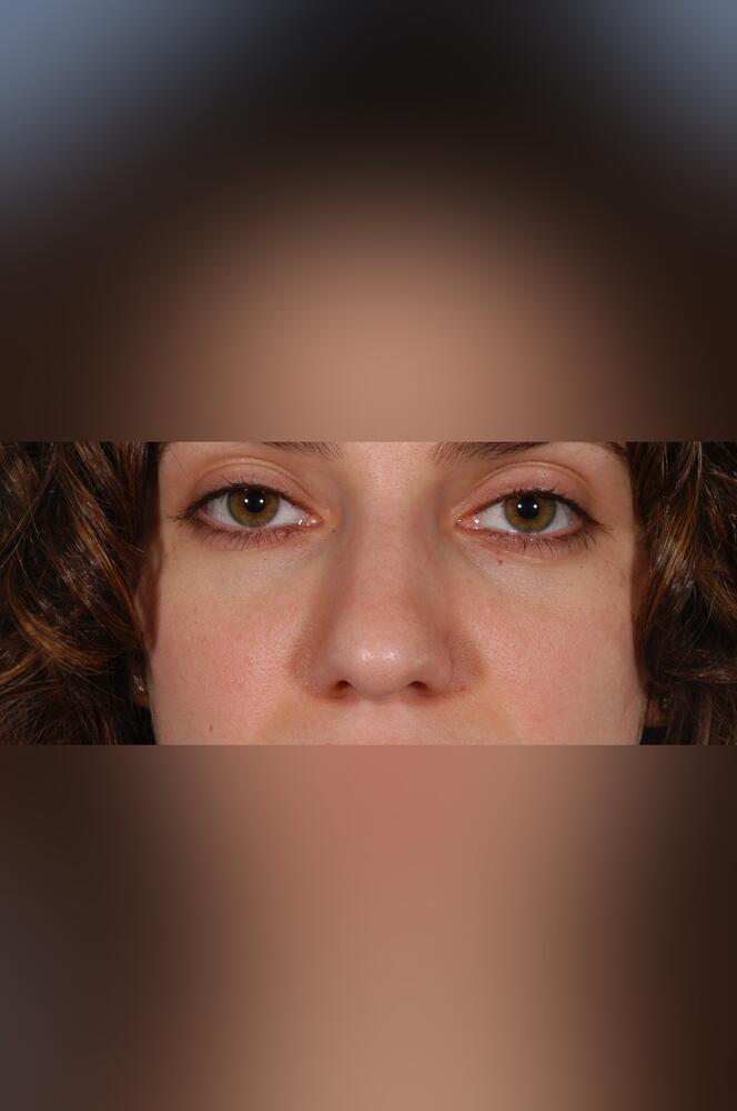 Nose surgery Before & After Image