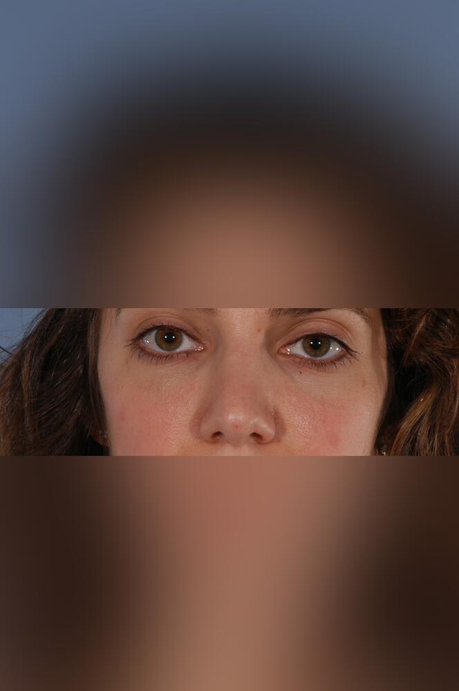 Nose surgery Before & After Image