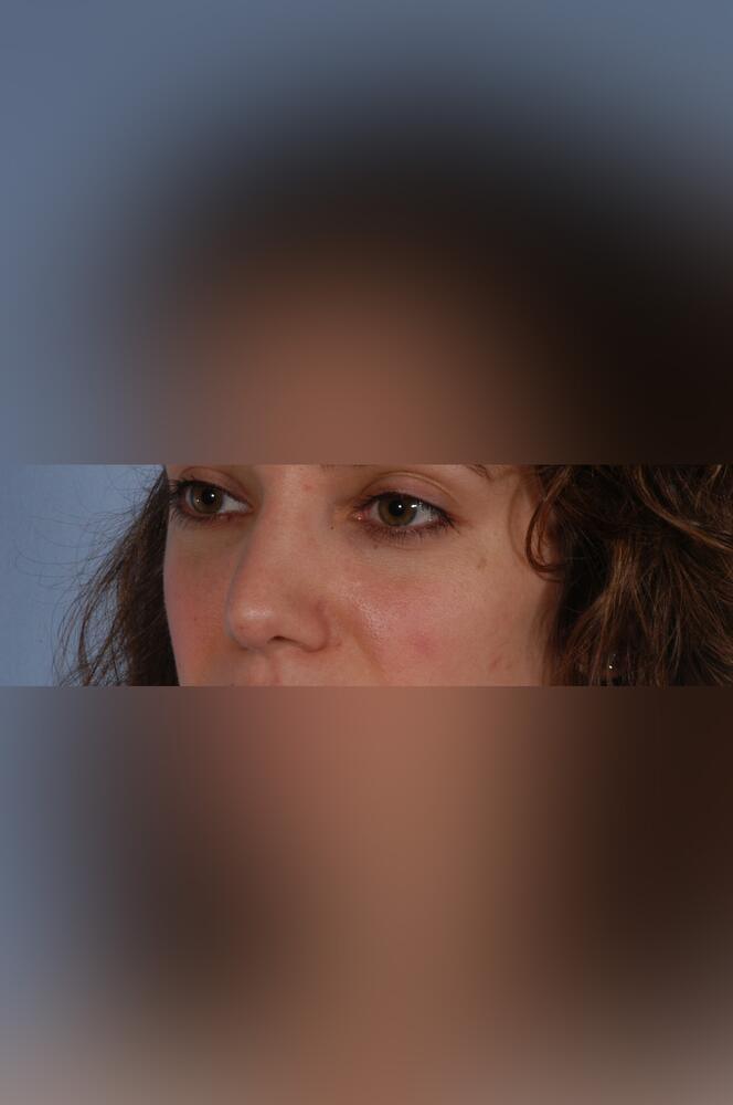 Nose surgery Before & After Image